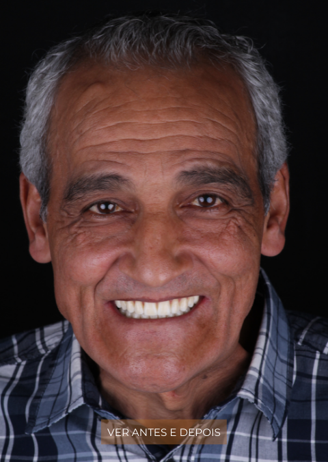 A funcionalidade de um novo sorriso