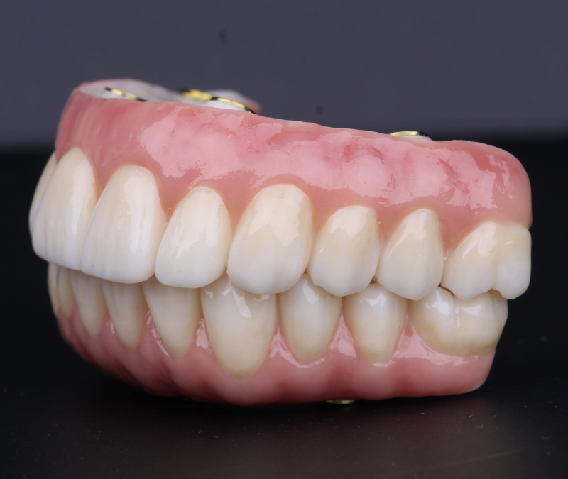 Fases do tratamento de Dentes Fixos em 1 Dia