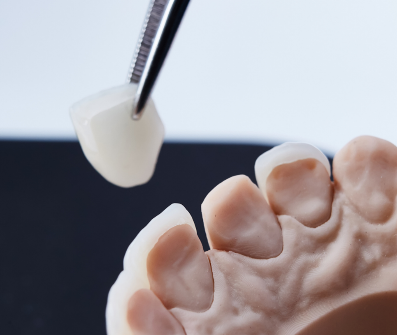 Facetas dentárias, o que são?