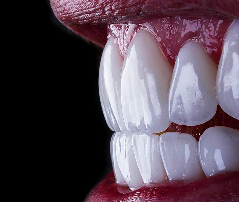 Tudo o que precisa de saber sobre facetas dentárias