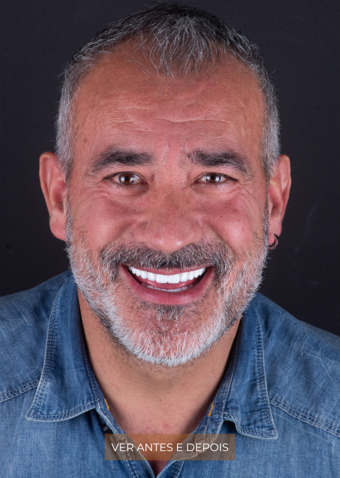 Sorriso Hollywood – Dentes Fixos em 1 Dia