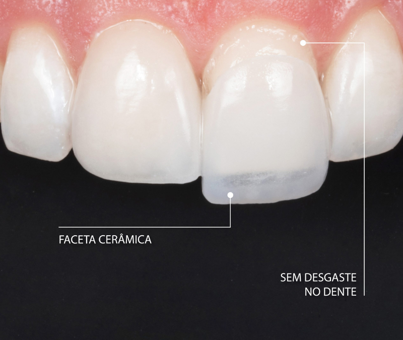 É necessário desgastar os dentes para realizar o tratamento de facetas dentárias?