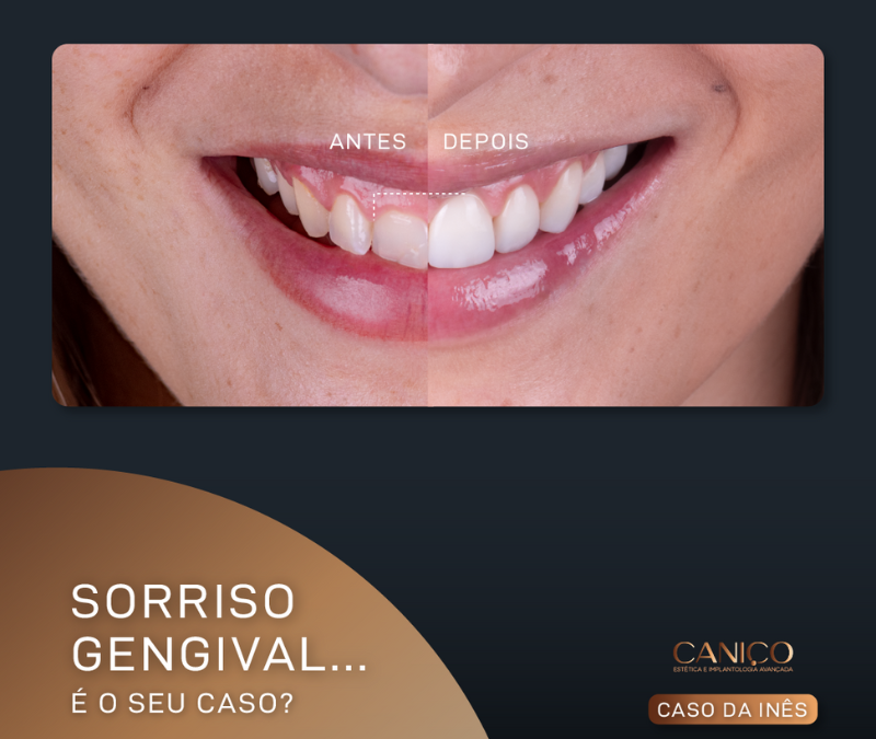 Sorriso gengival… É o seu caso?