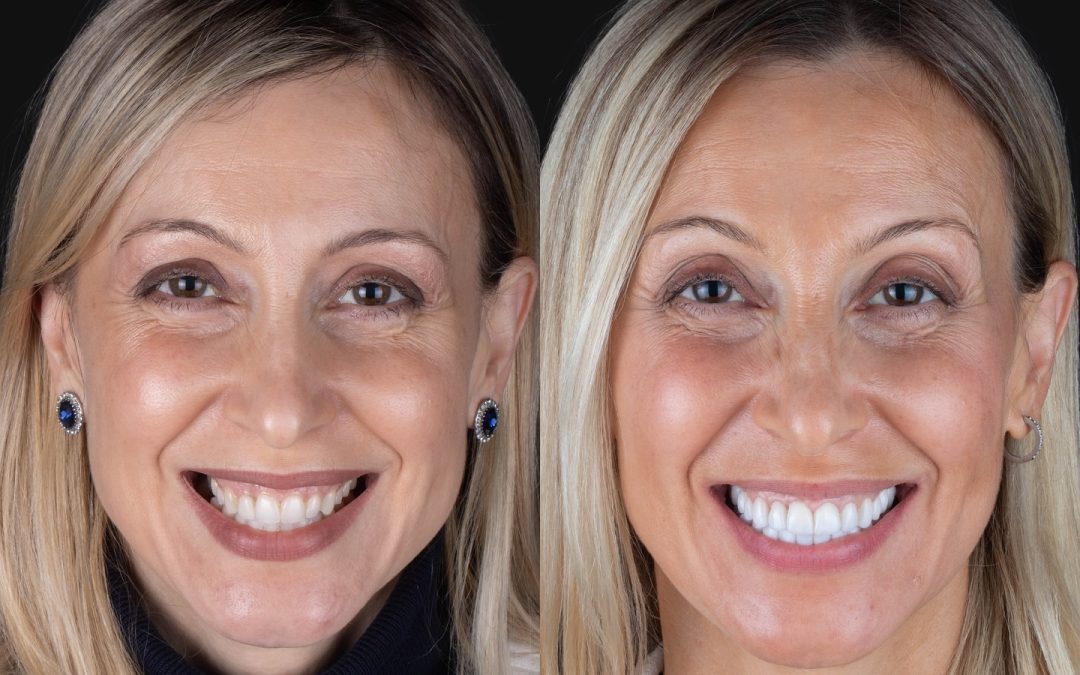 Novo sorriso aos 50 anos