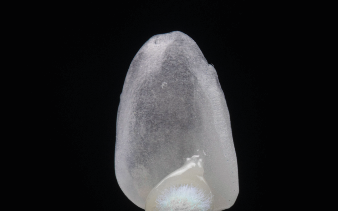 Sem desgaste dentário – facetas cerâmicas