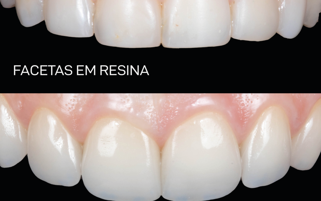 Facetas ceramicas vs facetas em resina